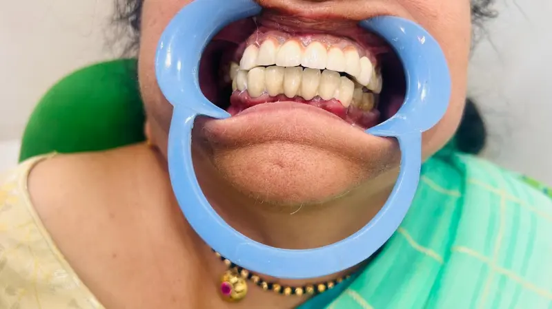 After treatment case 3