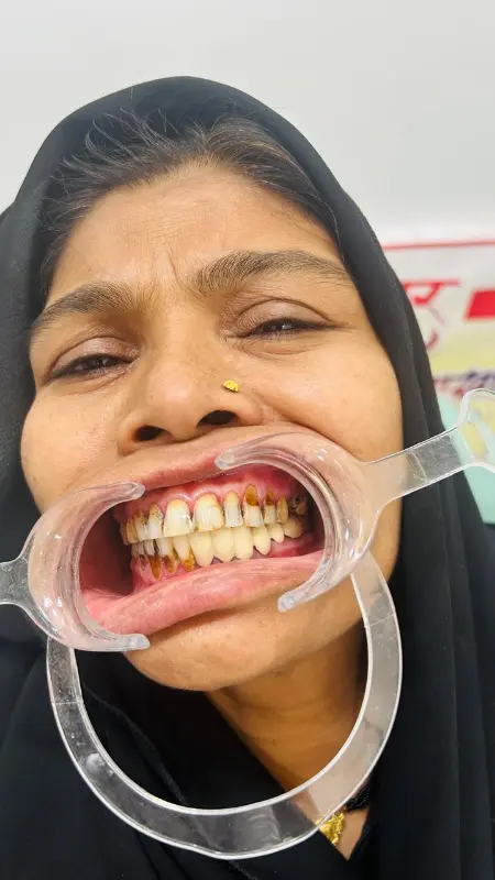 After treatment case 5