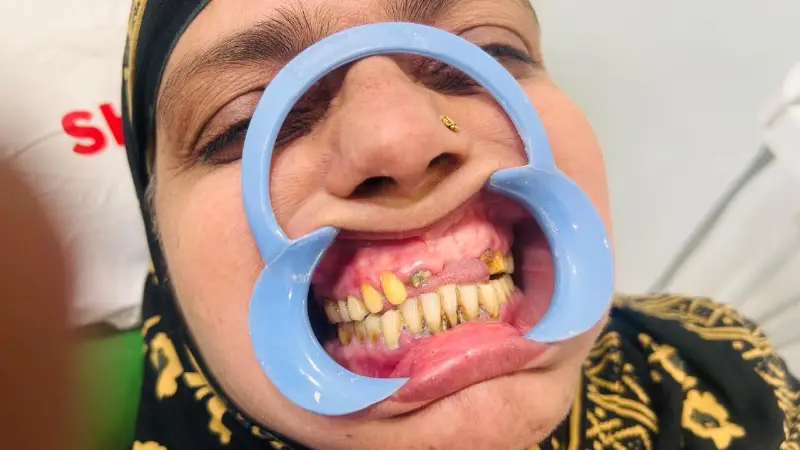 Before treatment case 1