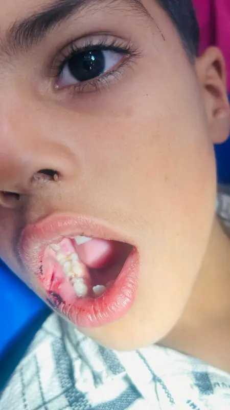 Before treatment case 4