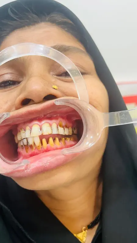 Before treatment case 5