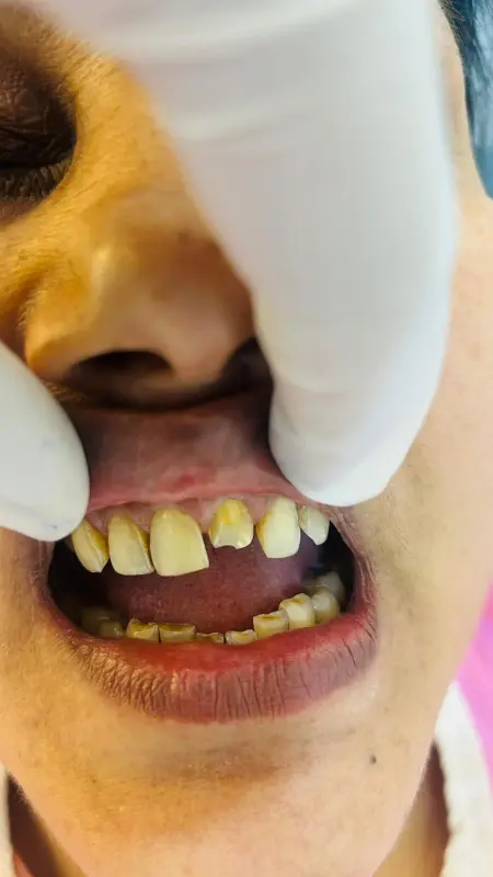 Before treatment case 6
