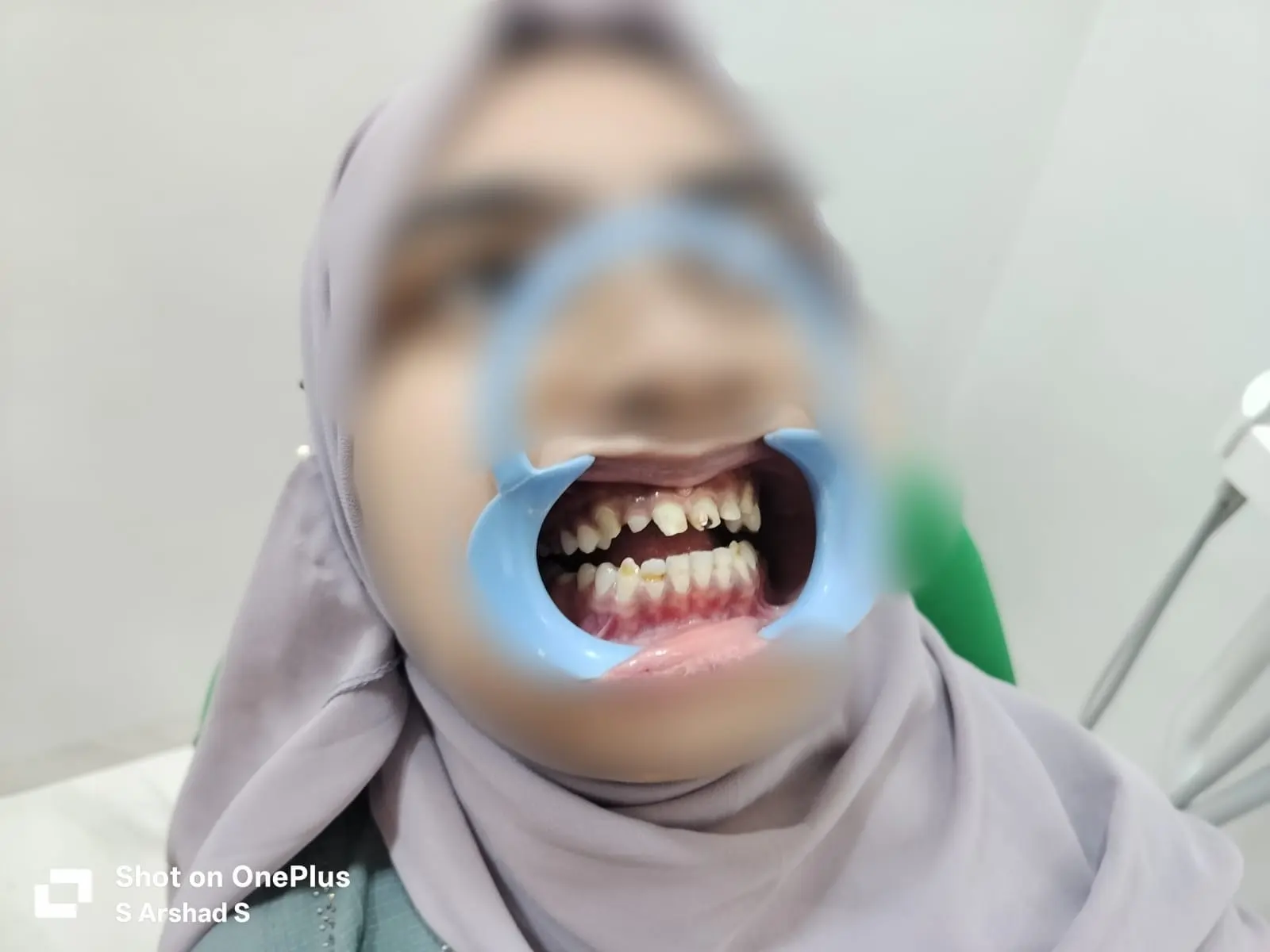 Before treatment case 9